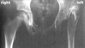 hip dysplasia resulting from severe birth defect